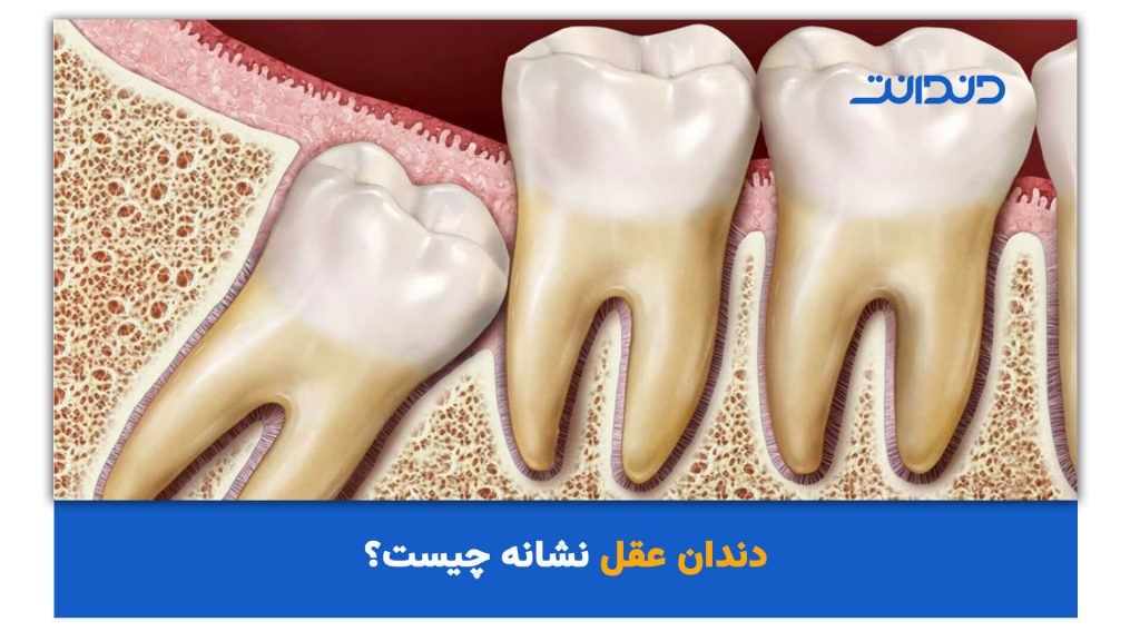 دندان عقل نشانه چیست