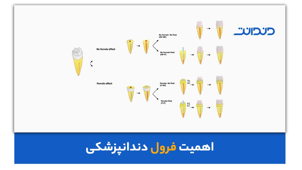 اهمیّت فرول دندانپزشکی