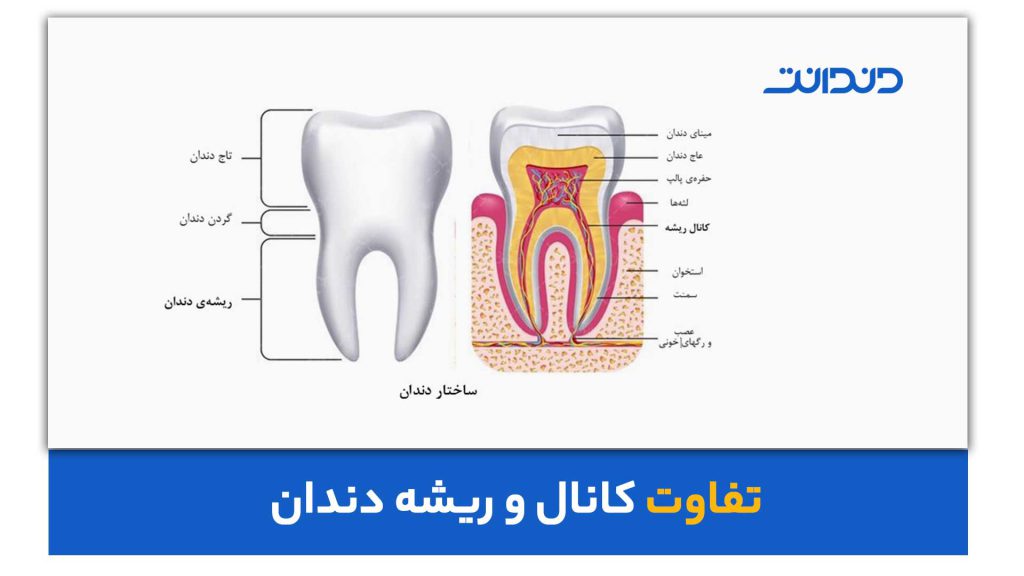 تفاوت کانال و ریشه دندان