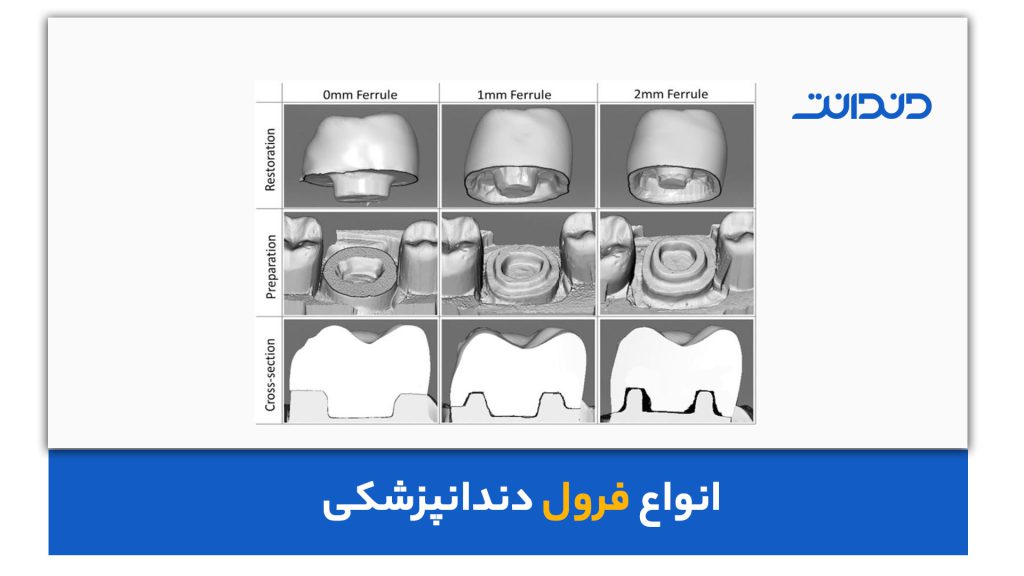 انواع فرول دندنانپزشکی