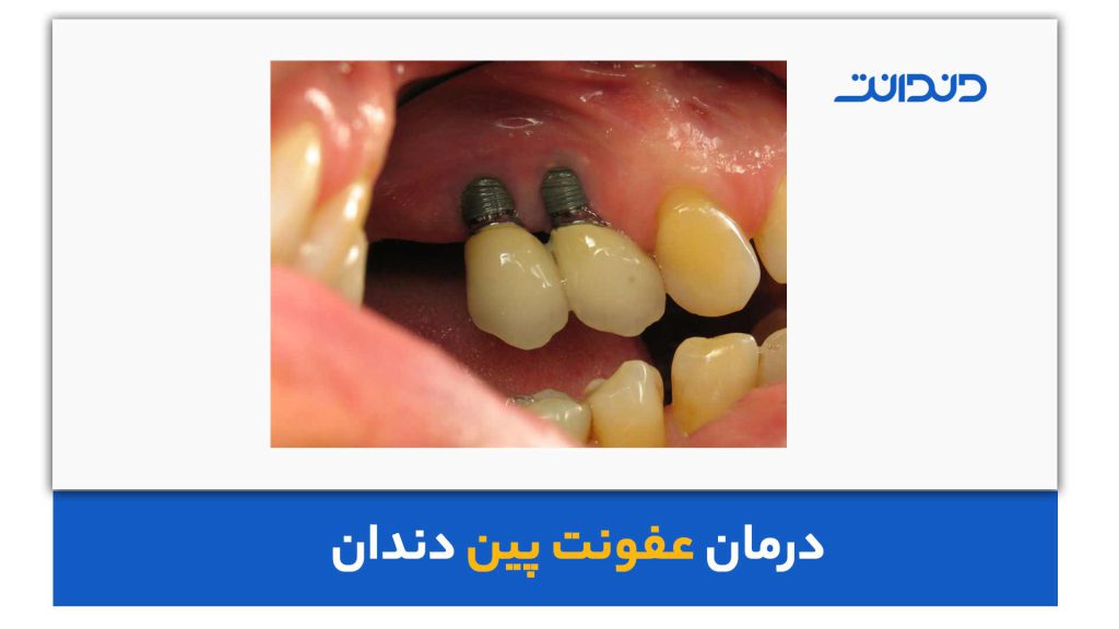 تفاوت پین دندان و پست دندان چیست؟