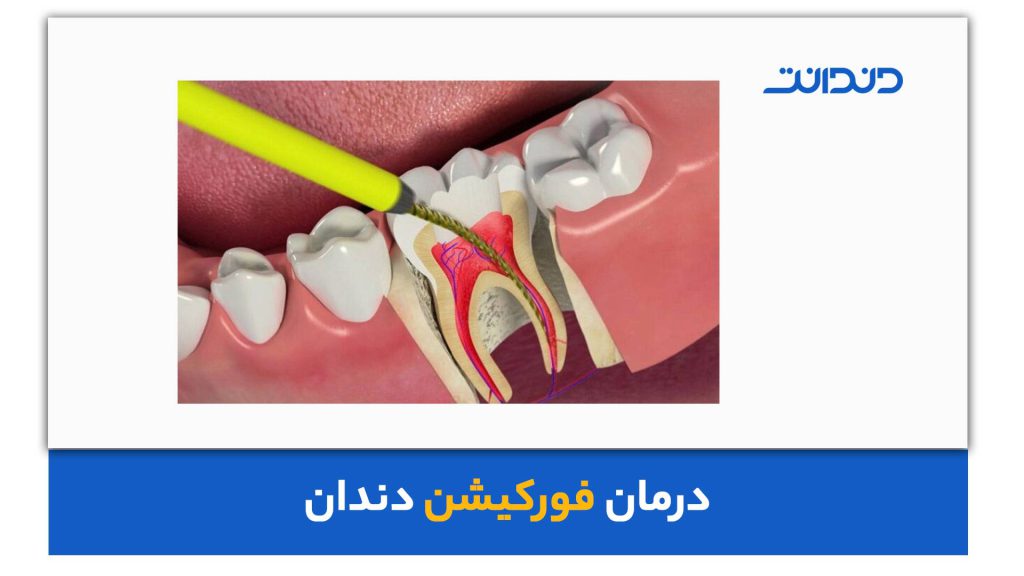 درمان فورکیشن دندان