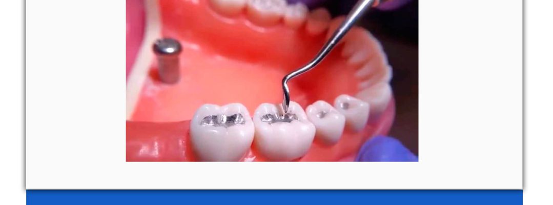 پین در دندانپزشکی چیست؟