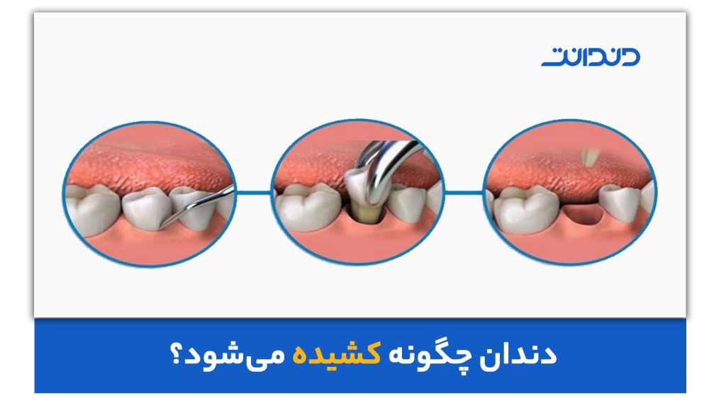 نحوه کشیدن دندان