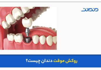 روکش موقت دندان چیست