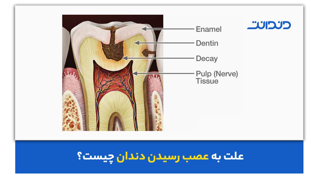 علت به عصب رسیدن دندان