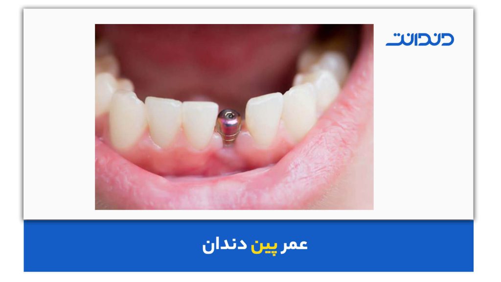 عمر پین دندان