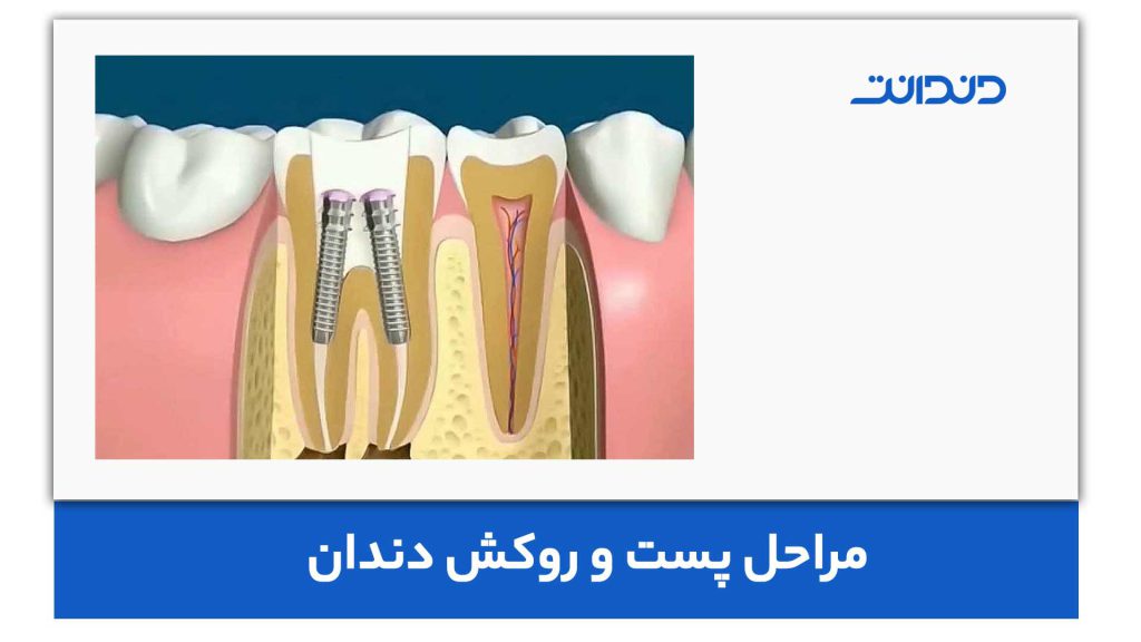 مراحل پست و روکش دندان