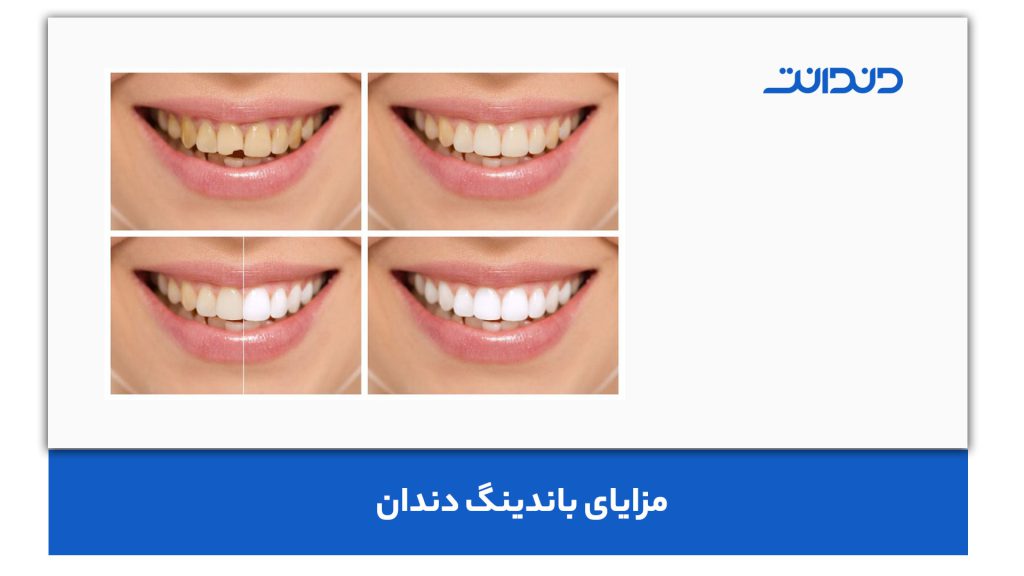 مزایای باندینگ دندان