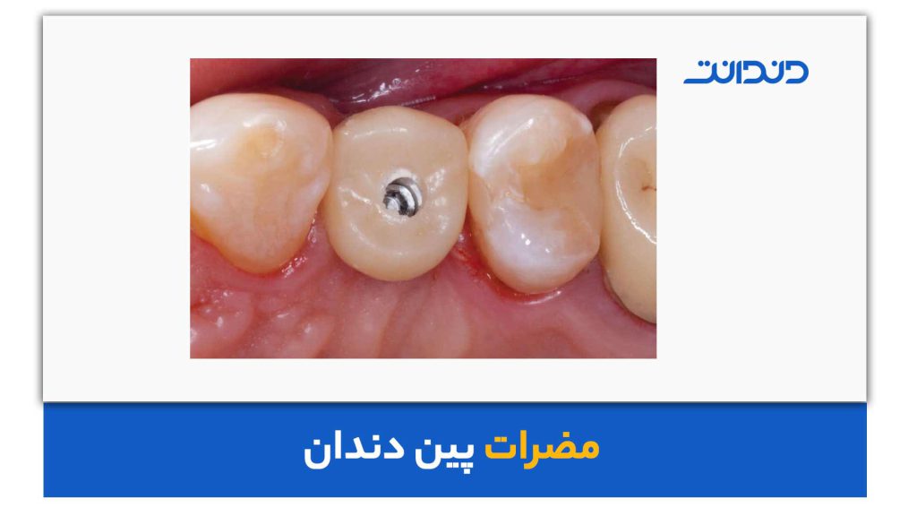 مضرات پین دندان