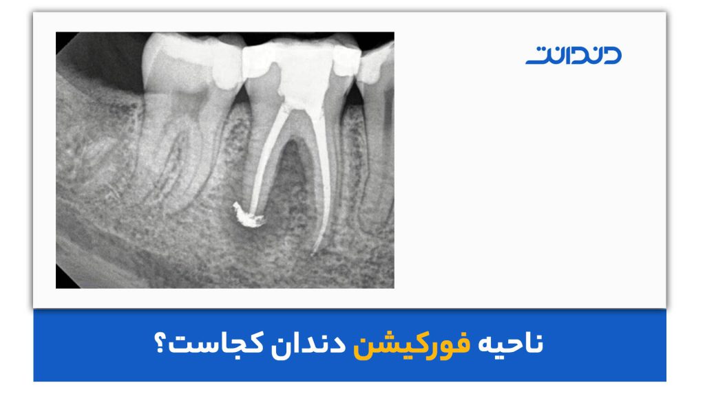 فورکیشن دندان