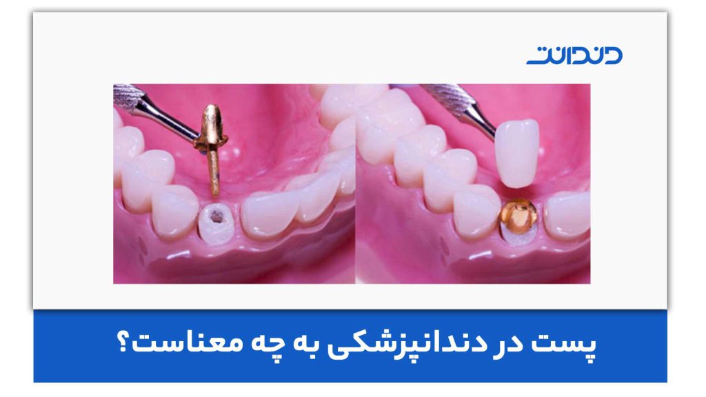 پست در دندانپزشکی به چه معناست؟