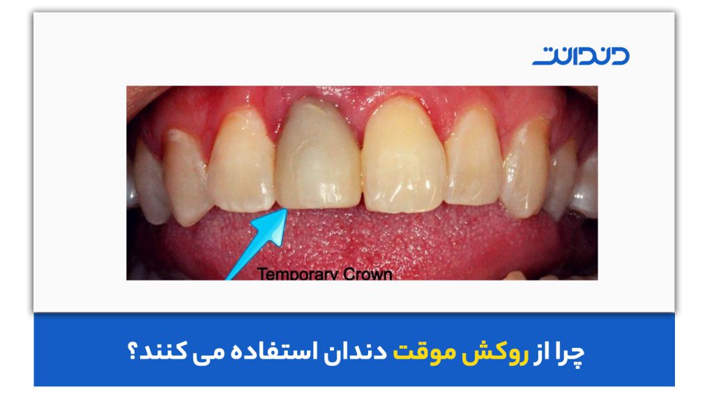 دلیل استفاده از روکش موقت دندان