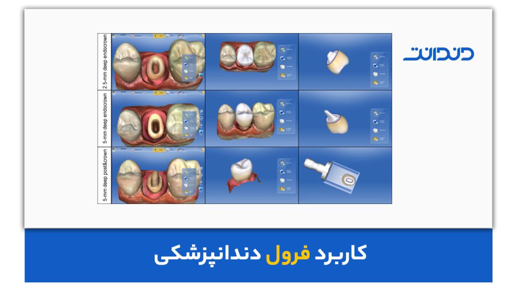 کاربرد فرول دندانپزشکی